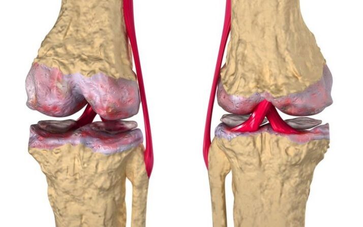 Osteoartritis de la articulación de la rodilla.