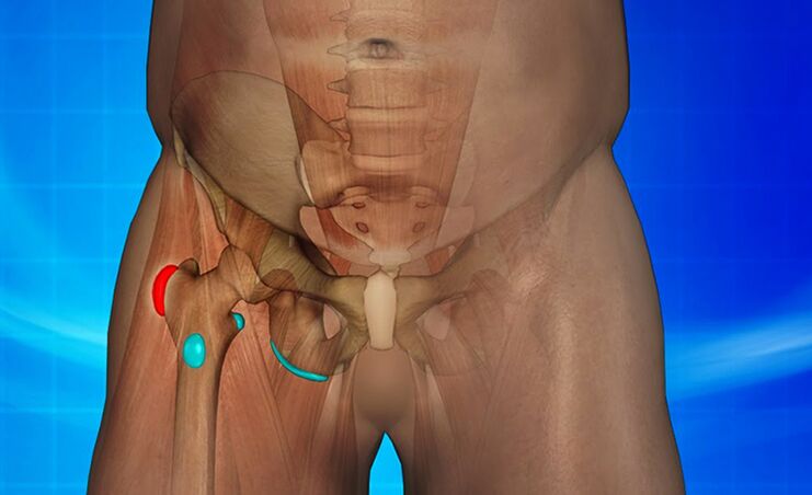 Inflamación de la articulación de la cadera como causa de dolor.