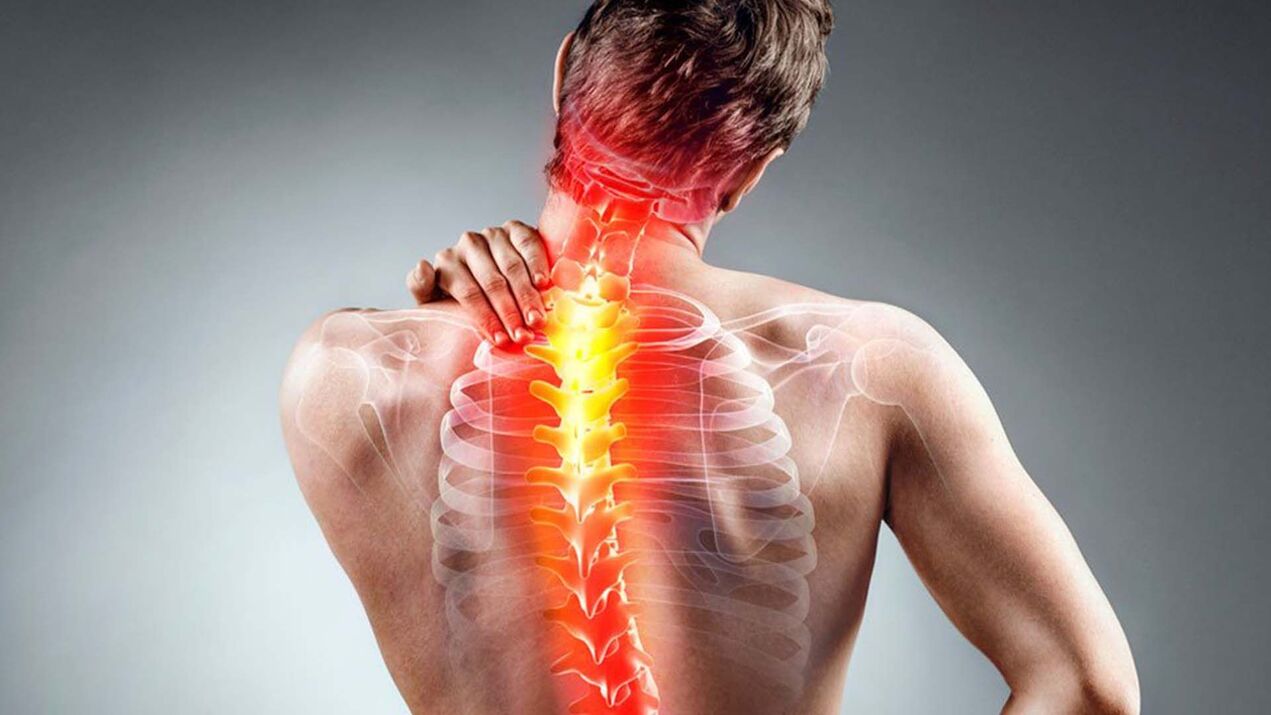síntomas de osteocondrosis espinal